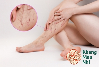Suy giãn tĩnh mạch khi mang thai có nguy hiểm không?
