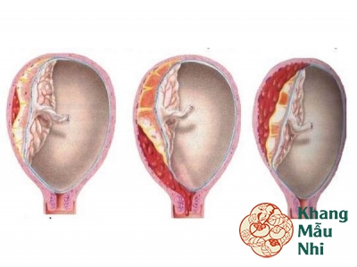 Bài thuốc chữa bóc tách túi thai theo Đông y