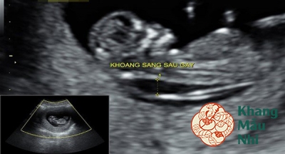 Siêu âm thai 12 tuần: Tầm quan trọng của đo độ mờ da gáy