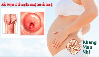 Mắc polyp tử cung khi mang thai: Không thể coi thường!