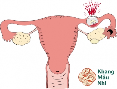 Tất tần tật những điều mẹ bầu cần biết về mang thai ngoài tử cung