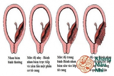 Khoảng 40% chị em đã từng sinh mổ 2 lần bị nhau cài răng lược