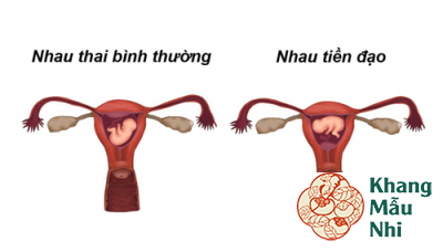 Nhau tiền đạo: Biến chứng sản khoa nguy hiểm trong thai kì