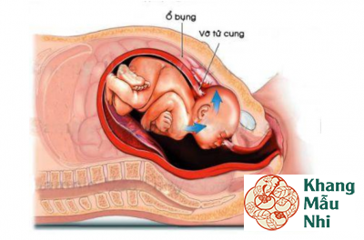 Tổng hợp 15 tai biến sản khoa thường gặp nhất