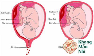 Bong nhau non nên sinh thường hay sinh mổ?