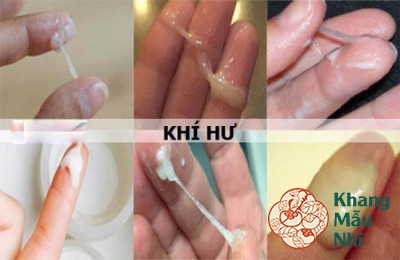Bà bầu ra khí hư màu nâu, trắng đục, vàng xanh là biểu hiện của bệnh gì?