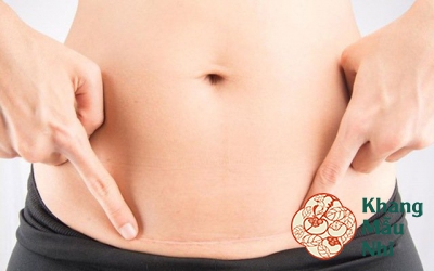 Khuyến cáo sau khi sinh mổ bao lâu thì nên có thai lại?