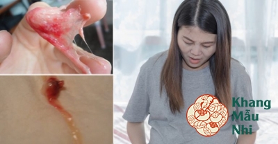 Sảy thai ra cục máu đông: Nỗi lo lắng của nhiều mẹ bầu