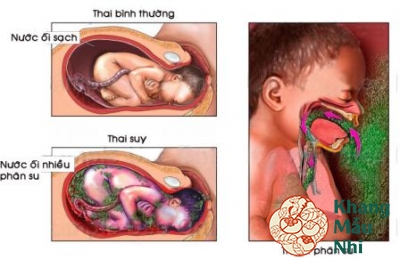 Suy thai: Nguyên nhân, biểu hiện, cách phòng tránh
