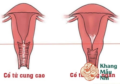 Bị cổ tử cung ngắn khi mang thai: Lời khuyên dành cho mẹ bầu