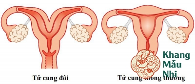 Tử cung đôi: “Thủ phạm” gây sảy thai ngoài ý muốn