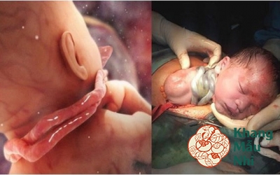 Dây rốn quấn cổ và những biến chứng mẹ bầu đừng coi thường