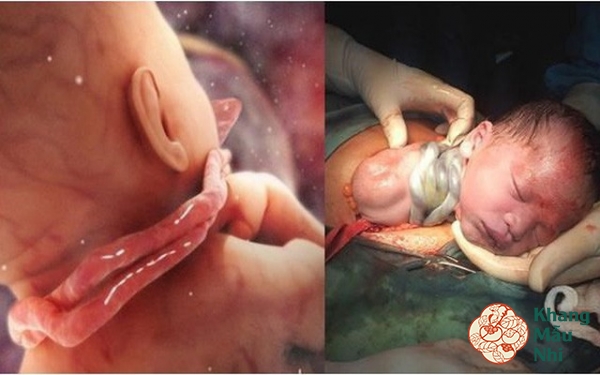 Dây rốn quấn cổ và những biến chứng mẹ bầu đừng coi thường