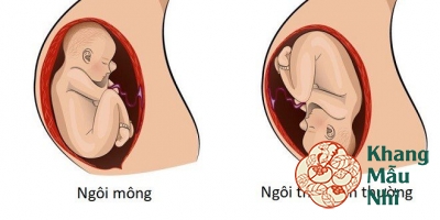 Ngôi thai ngược có thể sinh thường được không?