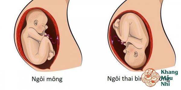 Ngôi thai ngược có thể sinh thường được không?