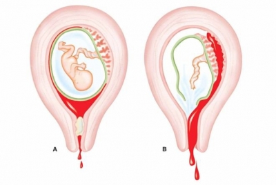 Ra máu 3 tháng đầu thai kì: Giải pháp nào hữu hiệu cho mẹ bầu?