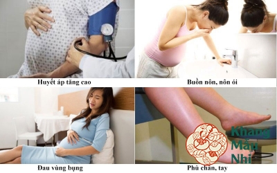 Tiền sản giật khi mang thai: Nguyên nhân, dấu hiệu, cách điều trị