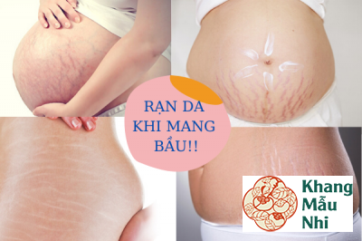 Mách bạn 8 bí quyết đơn giản tránh rạn da khi mang thai